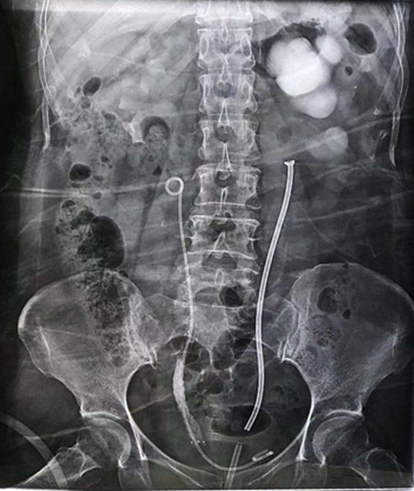 肾结石手术支架图片图片